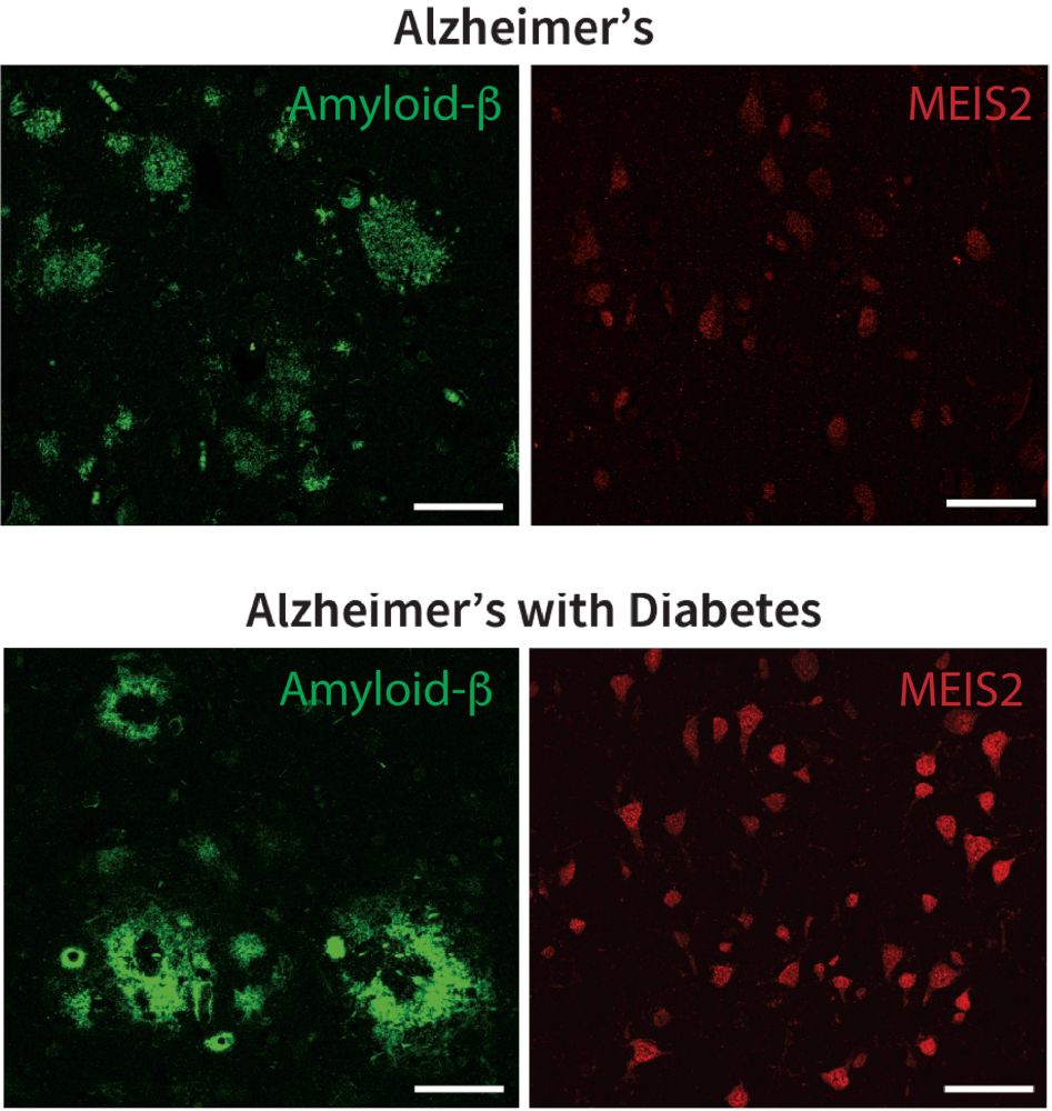 MEIS2 in human Alzheimer's disease cortex